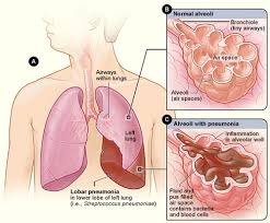 Illustration for article titled penyakit paru paru akibat rokok